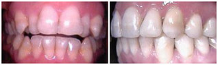 Ortodoncja przed i po zabiegu
