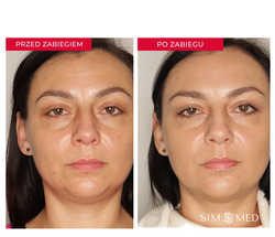 Cała twarz  - usuwanie zmarszczek toksyną botulinową przed i po zabiegu