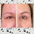 Operacje plastyczne powiek przed i po zabiegu