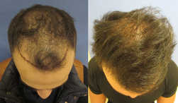 Przeszczep włosów FUE u mężczyzn przed i po zabiegu