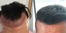 Zabiegi przeszczepiania włosów przed i po zabiegu
