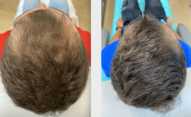 Zabiegi przeszczepiania włosów przed i po zabiegu