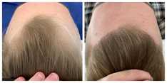 Zabiegi przeszczepiania włosów przed i po zabiegu