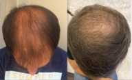 Zabiegi przeszczepiania włosów przed i po zabiegu