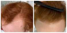 Zabiegi przeszczepiania włosów przed i po zabiegu