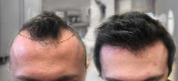 Zabiegi przeszczepiania włosów przed i po zabiegu
