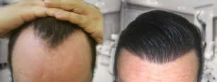 Zabiegi przeszczepiania włosów przed i po zabiegu
