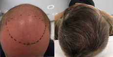 Zabiegi przeszczepiania włosów przed i po zabiegu