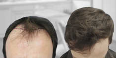 Zabiegi przeszczepiania włosów przed i po zabiegu