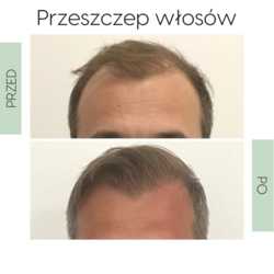 Zabiegi przeszczepiania włosów przed i po zabiegu