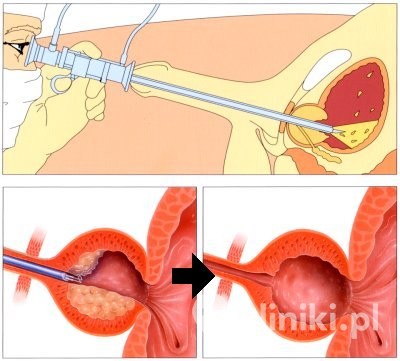 Elektroresekcja prostaty metodą TURP - rysunek poglądowy