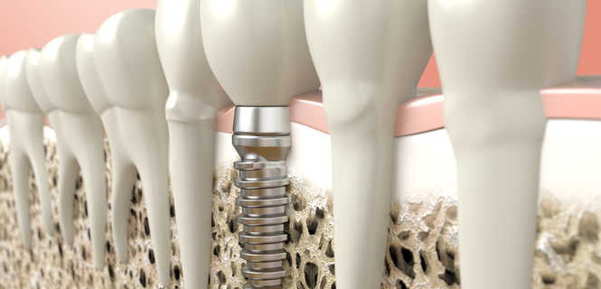 Implanty zębowe Bego