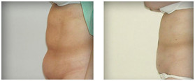 Liposukcja klasyczna SAL przed i po zabiegu