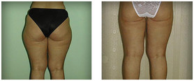 Liposukcja klasyczna SAL przed i po zabiegu