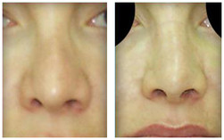 Operacja nosa kostnego przed i po zabiegu