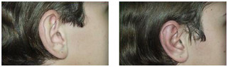 Operacje plastyczne uszu przed i po zabiegu
