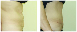 Plastyka brzucha przed i po zabiegu