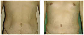 Plastyka brzucha przed i po zabiegu