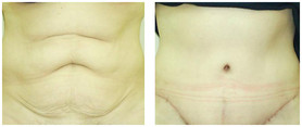 Plastyka ciała (body lifting) przed i po zabiegu