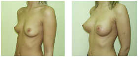 Powiększanie piersi przed i po zabiegu