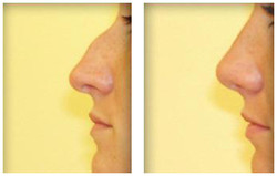 Usunięcie garbu nosowego przed i po zabiegu