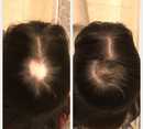 Trychologia przed i po zabiegu