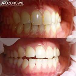 Higienizacja - profesjonalne czyszczenie zębów przed i po zabiegu