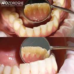 Higienizacja - profesjonalne czyszczenie zębów przed i po zabiegu