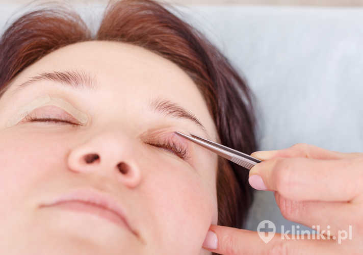 Kobieta kantopeksji - opieka po zabiegu