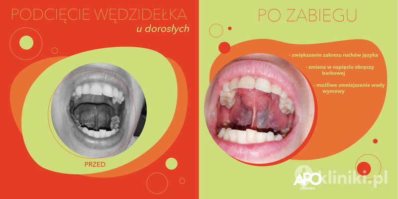 podci-cie-laserowe-w-dzide-ka-j-zyka-zdj-cia-przed-i-po-kliniki-pl