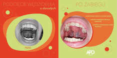 Podcięcie laserowe wędzidełka języka przed i po zabiegu