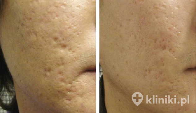 Laserowe usuwanie blizn - zdjęcia przed i po | Kliniki.pl