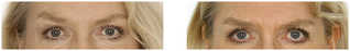 Zabiegi z użyciem botoksu przed i po zabiegu