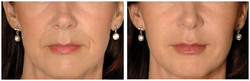 Bruzdy nosowo-wargowe - usuwanie zmarszczek kwasem hialuronowym przed i po zabiegu