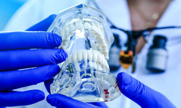 Implanty zębowe Astra Tech