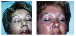 Laserowe usuwanie przebarwień skóry przed i po zabiegu