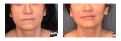 Modelowanie ust wypełniaczem przed i po zabiegu