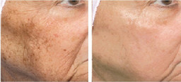 Policzki - usuwanie przebarwień laserem przed i po zabiegu