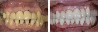 Protetyka stomatologiczna przed i po zabiegu