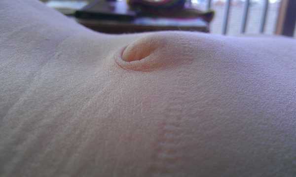 Przepuklina po operacji wyrostka i laparoskopii może powstać w miejscu nacięcia lub wprowadzenia trokarów, gdy ściana brzucha nie zrasta się prawidłowo