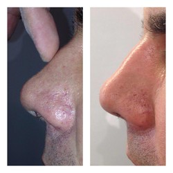 Usunięcie garbu nosowego przed i po zabiegu