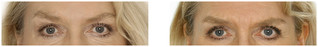 Usuwanie zmarszczek botoksem przed i po zabiegu