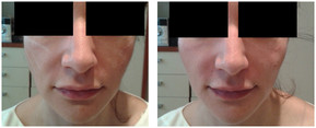 Wypełnienia i modelowanie wolumetryczne twarzy przed i po zabiegu