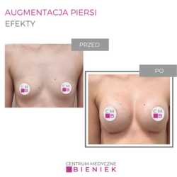 Augmentacja piersi - efekty