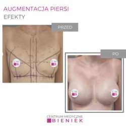 Augmentacja piersi - efekty