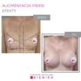 Augmentacja piersi - efekty