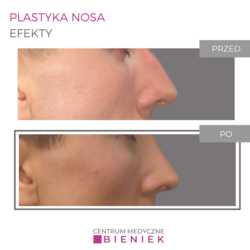 Plastyka nosa - efekty