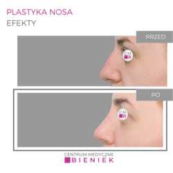 Plastyka nosa - efekty