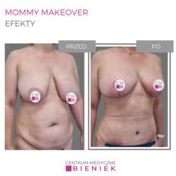 Mommy Makeover - efekty 