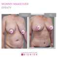 Mommy Makeover - efekty 